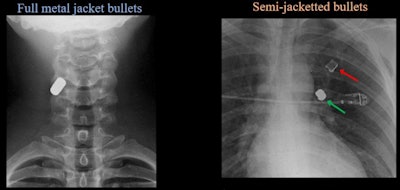 (Left) AP radiograph of cervical spine demonstrates single-density well-defined bullet within right posterolateral soft tissues of neck at C4 level, consistent with full metal jacket bullet (Right) Two different densities of ballistic material. Lower-density fragment in left upper lobe is copper jacket and high-density metal fragment is lead core, consistent with semi-jacketed bullet. Images courtesy of the ARRS.