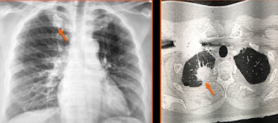Sclerosis involving the first anterior costochondral junction, secondary to degenerative changes, is a common finding. In this case, appearance was asymmetric and revealed to be overlapping lung cancer. Images and caption courtesy of the American Roentgen Ray Society.