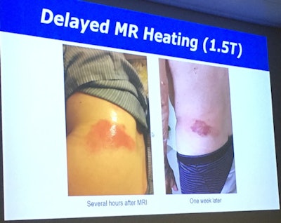 This patient suffered a thermal burn due to delayed MR heating after a 1.5-tesla scan. The U.K. Medicines and Healthcare products Regulatory Agency (MHRA) were told about the incident, and the vendor changed the coil that caused the injury. Image courtesy of Ilse Patterson.