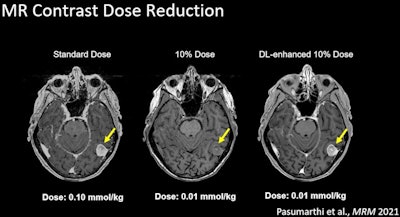 A 90% contrast dose reduction is feasible. All images courtesy of scientists at Subtle Medical/Greg Zaharchuk.