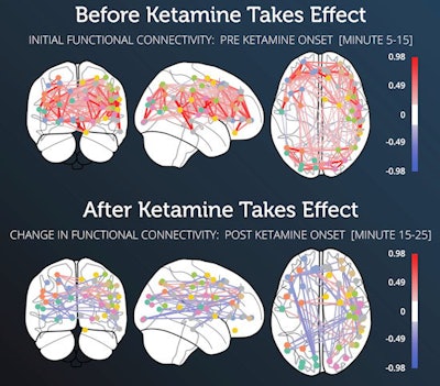 (Top) Absolute functional connectivity in a research subject for minutes five to 15 after he received the 57.75-mg intramuscular injection of ketamine. (Bottom) Subject's relative functional connectivity changes after the Ketamine took effect starting at minutes 15 to 25. Images courtesy of Kernel.