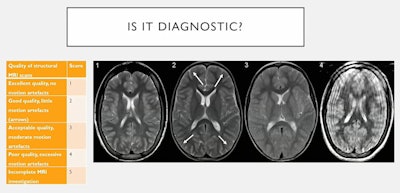 Creating a welcoming MRI environment for children could lead to better quality imaging, according to a presentation given by Dr. Clare Simcock at the annual meeting of the International Society for Magnetic Resonance in Medicine (ISMRM). This includes encouraging children to remain still during scanning to prevent motion artifacts upon image acquisition. Image courtesy of Dr. Clare Simcock.