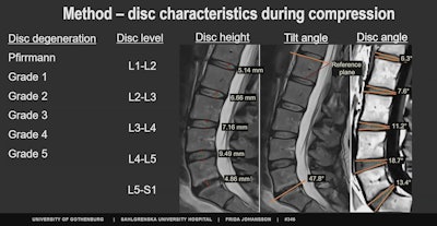 Research presented at the annual ISMRM says that a novel MRI registration method can track changes in intervertebral discs noninvasively while characterizing disc structures. These images are used to create heat maps showing compression on different parts of the spine. Image courtesy of Dr. Frida Johansson.