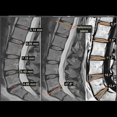 2022 05 11 21 38 7830 2022 05 10 Ismrm Mri Spine 400