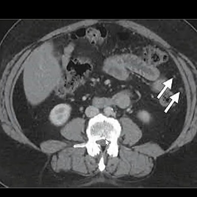 2022 05 12 14 24 6648 2022 05 11 Ismrm Mri Ct Ovarian Cancer 400