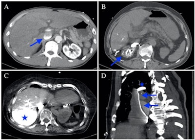 Contrast agent pooling and layering over the inferior vena cava (arrow). B Contrast agent pooling over the right renal vein (arrow). C Retrograde pooling of the contrast agent over the dependent part of the hepatic veins and parenchyma (star). D Contrast agent layering over the superior vena cava (arrows) and pooling over the arch of the azygos vein (star). Images and caption courtesy of BMC Emergency Medicine through Creative Commons Attribution 4.0 International License.