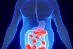 2022 05 12 18 43 6108 3 D Illustration Crohn Disease 400