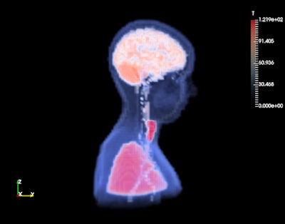 A temperature map estimated by TESS overlaid on a blood perfusion map. Image and caption courtesy of Eros Montin and the ISMRM.
