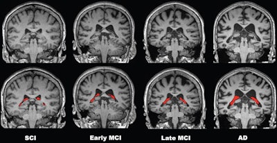 Comparisons of four representative 3-tesla brain MRI scans of choroid plexus (CP) volume (red) according to disease stage over the cognitive impairment spectrum. CP volume is greater in the patient with Alzheimer disease (AD) than in those with subjective cognitive impairment (SCI) or mild cognitive impairment (MCI). All patients were 75-year-old women. Image courtesy of Radiology.