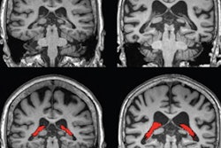 2022 05 17 04 23 5887 2022 05 17 Choroid Plexus Mri 400