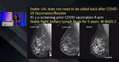 Radiologists are more experienced with axillary lymphadenopathy related to COVID-19 vaccines, according to a presentation given by Dr. Debra Ikeda (inset) from Stanford University. Here, images of a 41-year-old patient show a stable right axillary lymph node before vaccine administration, meaning the patient doesn't need to be called back in for an unnecessary biopsy. Ikeda also talked about the many challenges breast imagers have faced during the COVID-19 pandemic.