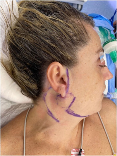 A patient with ultrasound gel applied to her hair to prevent hair from interfering with the surgical site. Image courtesy of Boschetti et al. Licensed by CC BY 4.0.