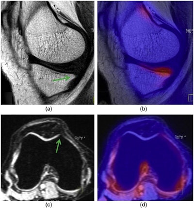 A 30-year-old woman with bilateral knee pain and grade 1 osteophytes in both MT (a) sagittal T1 TSE fat-suppressed and Troc (c) reformatted axial 3D MEDIC compartments, but corresponding fused PET/MRI images (b,d), showed that MT osteophytes had higher SUVmax value (2.54) than the Troc osteophytes SUVmax value (0.73). Image courtesy of Clinical Radiology.
