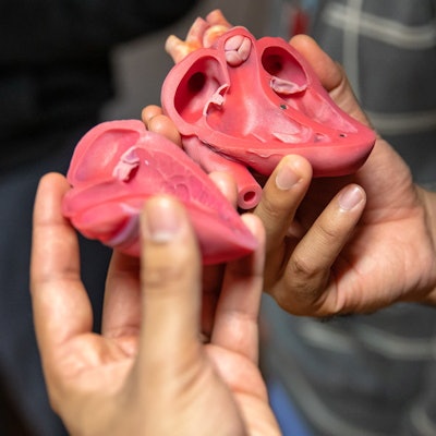 Sample of a 3D-printed model produced for surgical planning by Tampa General Hospital and USF Health Morsani College of Medicine. Image courtesy of Tampa General Hospital.