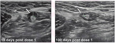 (Left) An increased cortical thickness of 4 mm (arrow) is seen in a transverse image of left axilla on initial breast ultrasound in a 33-year-old woman, 19 days after the first dose of the Pfizer COVID-19 vaccination to left upper extremity. (Right) About 100 days after the woman received her first COVID-19 vaccine dose, her ultrasound showed a cortical thickness of 2 mm (arrow), consistent with resolution of left axillary lymphadenopathy (arrow). The woman underwent a second dose two days after the initial ultrasound.Image courtesy of the AJR.