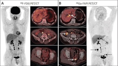 Images from a 59-year-old man who presented with yellow discoloration and pruritus of the skin for three months. A liver function test revealed increased bilirubin. (A) F-18 FDG-PET/CT images demonstrate no abnormal uptake throughout the abdomen, although the corresponding CT scan shows intrahepatic bile duct dilatation. (B) Ga-68 FAPI-PET/CT revealed increased uptake in the perihilar bile duct (SUVmax, 8.2). Three areas of intensive uptake were also observed on the thickening mesentery in the right lower abdomen and pelvic cavity (dashed arrows; SUVmax, 8.6). Slightly elevated Ga-68 FAPI uptake was observed around the dilated intrahepatic bile duct, suggesting cholangitis secondary to obstructive perihilar bile duct carcinoma. Mesentery tissue sample biopsy revealed metastatic adenocarcinoma from biliary cancer. Image courtesy of Radiology.
