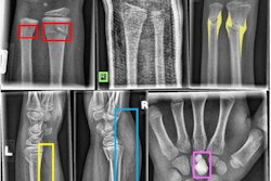 2022 05 23 16 55 9486 2022 05 23 Wrist Fractures 20220523164938