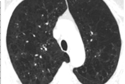 2022 05 23 22 09 8948 2022 05 24 Ct Emphysema Deep Learning Figure2 400