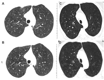 Inspiratory axial noncontrast CT scans obtained at baseline and five-year follow-up in two participants demonstrate emphysema progression, according to the deep-learning automated method. (A) Baseline scan shows mild emphysema in a 49-year-old man. (B) Image obtained at five-year follow-up shows progression to moderate emphysema. Forced expiratory volume in one second (FEV1) decreased by 677 mL. (C) Baseline scan shows moderate emphysema in a 62-year-old man. (D) Image obtained at five-year follow-up shows progression to confluent emphysema. FEV1 decreased by 502 mL. Images and caption courtesy of the RSNA.