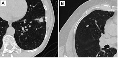 Examples of axial CT images of pulmonary nodules included in the multicenter reader study. (A) Malignant nodule with a lung cancer prediction score of 10 on the AI software. (B) Benign nodule with a lung cancer prediction score of 2. Images and caption courtesy of the RSNA.
