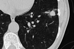 2022 05 24 00 22 0759 2022 05 24 Ai Lung Nodules 20220524004416