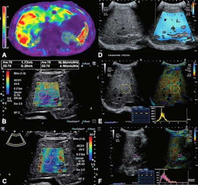 Images show MR elastography and quantitative ultrasound images in 16-year-old boy with Fontan-associated liver disease and elevated liver shear stiffness (5.4 kPa with gradient-recalled echo MR elastography). (A) Axial MR elastogram with 95% confidence map overlay shows a stiff (5.4 kPa) heterogeneous liver. Image colors indicate stiffness (in kPa) according to the scale left of the elastogram image. (B) A transverse 2D shear-wave elastography ultrasound image with shear-wave speed of 1.73 m/sec (9 kPa). (C) A transverse shear-wave dispersion map with dispersion of 16.86 m/sec/kHz. (D) A split-screen transverse image shows a liver attenuation measurement of 0.46 dB/cm/MHz. (E) A split-screen transverse image shows a normalized local variance measurement of 1.24. (F) A split-screen longitudinal image shows a hepatorenal index measurement of 1.07. Images courtesy of RSNA.