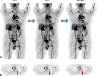 A 77-year-old man (78 kg; BMI 24 kg/m2) with multifocal lymphadenopathy of unknown origin. MIP views (a) and axial PET slices (b) of F-18 FDG PET90, PET45, and PET45AI. Detection of small left suprahilar lymphadenopathy in all PET series (vertical arrows in b) with respective standard standardized uptake value corrected for lean body mass (SULmax) of 1.8 (PET90), 2.3 (PET45), and 1.7 g/ml (PET45AI). Nonetheless, PET45 images are noisier than PET90 or PET45AI images, particularly in the liver. Image courtesy of the European Journal of Nuclear Medicine and Molecular Imaging.