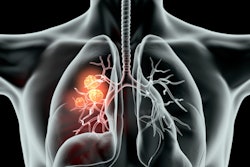 2021 02 04 17 15 7107 Cancer Lung 3 D Black 400