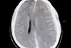2021 03 04 00 11 9158 Ct Brain Hemorrhage Edema 400