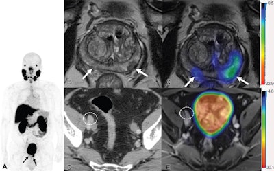 Images show F-18 DCFPyL PET/MRI and contrast-enhanced CT in a 65-year-old man with clinical T3 stage prostate cancer who underwent bone scintigraphy with negative findings (not shown). (A) Anteroposterior maximum intensity projection image of F-18 DCFPyL PET/MRI shows PSMA-avid primary tumor (arrows). (B) Axial T2-weighted MRI of the prostate and (C) corresponding fused F-18 DCFPyL PET/MRI in the prostate show multifocal PSMA-avid primary tumors involving bilateral peripheral zone of the gland (arrows). (D) Axial CT image shows a 1.1-cm right external iliac lymph node, suspicious for nodal metastasis, by size criteria (N1; circle). (E) Axial fused F-18 DCFPyL PET/MRI does not show corresponding increased tracer activity (N0; circle). At time of radical prostatectomy, lymph node sampling was negative for metastases (pT3a pN0). Image courtesy of Radiology.