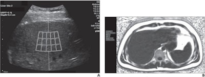 A 23-year-old man with body mass index of 25.1. (A) For ultrasound-derived fat fraction (UDFF) measurement, the operator places crossbar at liver capsule, with sample region of interest fixed 1.5 cm deep from crossbar, to ensure measurement obtained sufficiently deep to liver capsule. Overall UDFF was 3%. (B) Median MRI proton density fat fraction (PDFF) from three acquisitions was 3%, demonstrating agreement. Images courtesy of the American Roentgen Ray Society and the American Journal of Roentgenology.