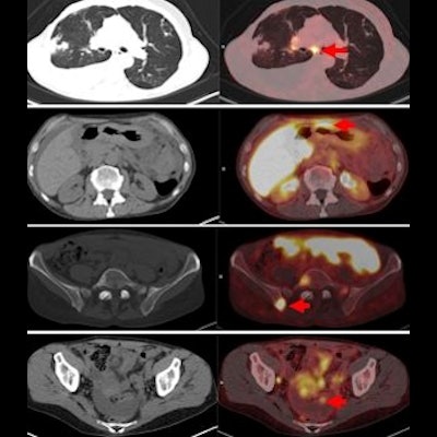 PET, CT Scans, and Thermagraphy for Breast Cancer Imaging