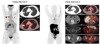 Images are from a 59-year-old woman with treated invasive lobular breast cancer and suspicion of disease recurrence. FDG-PET/CT showed FDG-avid lung opacities suspicious for lung cancer recurrence, but lung biopsy was benign. FES-PET/CT determined lung lesions were not FES-avid, but there were FES-avid nodal, gastrointestinal, osseous, and peritoneal lesions. Image courtesy of Dr. Gary Ulaner and SNMMI.