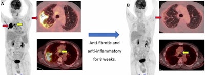 A 71-year-old male diagnosed with COVID-19 in October 2020. After treatment, he was discharged from the hospital. He was readmitted to the hospital for respiratory failure in January 2021 and underwent F-18 FDG PET/CT. (A) Maximum intensity projection whole-body image and axial fused PET/CT show FDG-avid (SUVmax, 12.7) consolidation in the right lung (red arrow). Non-tracer-avid changes are noted in both lungs on CT. FDG-avid mediastinal lymph nodes (SUVmax, 4.4) (yellow arrow) were also noted. The patient was given steroids and pirfenidone for two months. He showed significant improvement in symptoms with no oxygen requirement. (B) Follow-up PET/CT reveals complete resolution of the lung lesion and non-avid residual fibrotic changes in both lungs (red arrow). Mediastinal lymph nodes also show a decrease in avidity (SUVmax, 2.5). Image courtesy of Yogita Khandelwal.