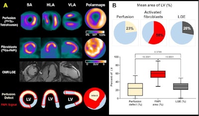 A representative case with acute anterior wall myocardial infarction: Myocardial perfusion images using technetium-99m tetrofosmin at rest (first row), Ga-68 FAPI-46 PET (second row), late gadolinium enhancement (LGE) from cardiac magnetic resonance (third row), and schematic drawings of the left ventricle (fourth row). Area of fibroblast activation exceeds infarct area and LGE signal, the most common type of myocardial FAP-distribution. (Bottom left) Mean areas of perfusion defect, FAPI-signal, and LGE of 35 studied patients. (Bottom right) Global myocardial FAP volume early after acute myocardial infarction inversely correlates with left ventricular ejection fraction (LV-EF) at follow-up in the chronic stage.