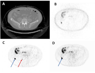Representative axial image from a test set imaging study. From top left to bottom right: CT (A), NAC-PET (B), original AC-PET (C), AI-generated AC-PET (D). The blue arrow indicates one lesion that was observed in both images, and the red arrow indicates a lesion that was missed (i.e., not de-tected by expert nuclear medicine physicians) in AI image. NAC = Non-Attenuation Corrected. AC = Attenuation-Corrected. Courtesy of Kevin Ma, PhD, et al.