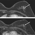 2022 06 15 20 27 4034 2022 06 14 Rsna Abbreviated Breast Mri 400