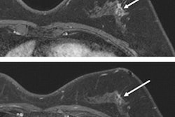 2022 06 15 20 27 4034 2022 06 14 Rsna Abbreviated Breast Mri 400