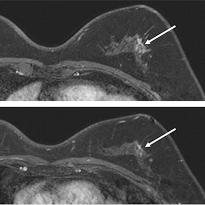 2022 06 15 20 27 4034 2022 06 14 Rsna Abbreviated Breast Mri 400