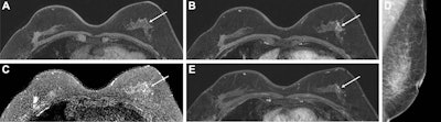 Images show a 57-year-old woman who had contralateral breast tumor recurrence detected at abbreviated MRI 30 months after breast-conserving surgery. (A) Precontrast and (B) postcontrast T1-weighted MRI scans show a 1.6-cm focal heterogeneous non-mass enhancement (arrow) in the left upper outer breast. (C) Axial T2-weighted MRI scan shows no abnormal findings at the corresponding site (arrow). MRI-guided biopsy revealed low-grade DCIS. (D) Left mediolateral oblique mammogram six months before MRI shows no abnormal findings. (E) On retrospective review, there was a small non-mass enhancement (arrow) at MRI one year prior, but it was interpreted as a benign finding by a radiologist at that time. The lesion was finally proven to be invasive ductal carcinoma in the background of DCIS at the surgical histopathologic examination. Images courtesy of the RSNA.