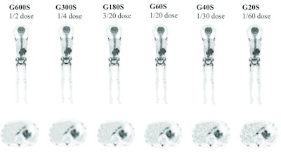 Imaging of an 11-year-old child with neuroblastoma, with the maximum intensity projection (MIP) of the half-dose image and coronal view and axial images of the serial dose reduction image generated by reduced count. The overall image quality scores of G600 to G20 were 5, 5, 4, 3, 3 and 2 points. The lesion was even identifiable reduced down to a 1/60-dose. Image courtesy of Dr. Wanqi Chen.