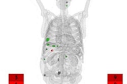 2022 06 16 23 52 4275 2022 06 17 Ai Lutathera 20220616232936