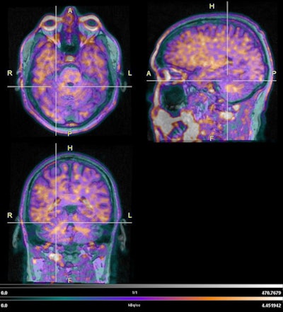 Flortaucipir-PET images show tau deposits with substantial frontal and temporal uptake, compared with cerebellar gray reference region (denoted by crosshairs). Image courtesy of SNMMI, Juin Zhou, and Renaissance School of Medicine at Stony Brook.