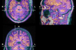2022 06 20 22 02 7065 2022 06 21 Snmmi Zhou Pet Mri Tau Dementia 20220620222021