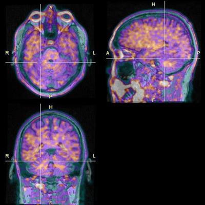 2022 06 20 22 02 7065 2022 06 21 Snmmi Zhou Pet Mri Tau Dementia 20220620222021