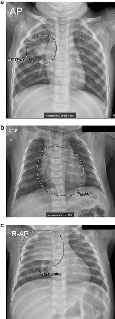 Examples of results analyzed by the AI-based lesion detection software. (A) A 17-month-old boy with pneumonia in the right upper lobe. The software detected consolidation with an abnormality score of 91% in the right upper lobe, as marked in the grayscale map. (B) A 3-month-old boy with a cardiothoracic ratio of 50%, within normal range. The software detected cardiomegaly with an abnormality score of 56% on the anteroposterior chest radiograph. (C) A 4-month-old girl without remarkable findings on the chest radiograph. The software detected normal thymus as consolidation and nodule with an abnormality score of 88%. Image courtesy of Scientific Reports.