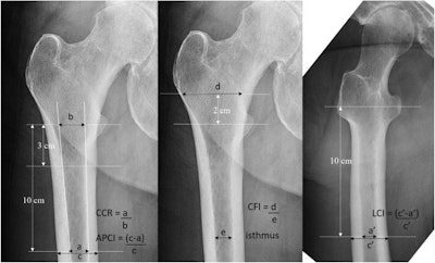 Measuring methods of each x-ray image of the hip: Canal to calcar ratio (CCR), AP cortical thickness index (APCI), canal flare index (CFI), and lateral cortical thickness index (LCI). Image courtesy of the Journal of Arthroplasty.
