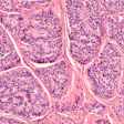 2022 06 24 17 22 8341 Carcinoid Neuroendocrine Tumor 400