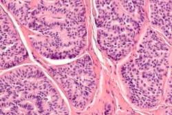 2022 06 24 17 22 8341 Carcinoid Neuroendocrine Tumor 400