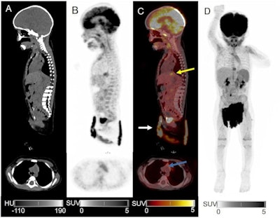 CT, PET, and fused PET/CT in sagittal, axial and maximum intensity projection reconstructions (A-D) after 120 second PET acquisition. Color scale from 0-5 standard uptake value (SUV). No pathological uptake, but reactive accumulation in the distal part of esophagus (yellow arrow), physiological thymic uptake (blue arrow), and accumulated urinary activity in the diaper (white arrow).